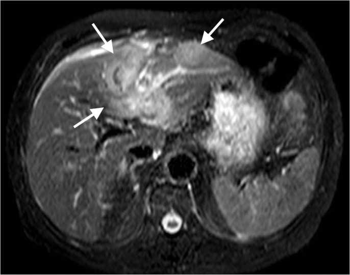 김한나외 a b c d Fig. 1. A 78-year-old man with primary hepatic lymphoma.