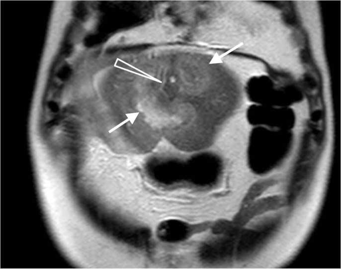 lobulated hyperintense mass (arrows) in the left hepatic lobe.