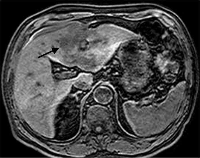 lobulated heterogeneous hyperintense mass (arrows), surrounding the