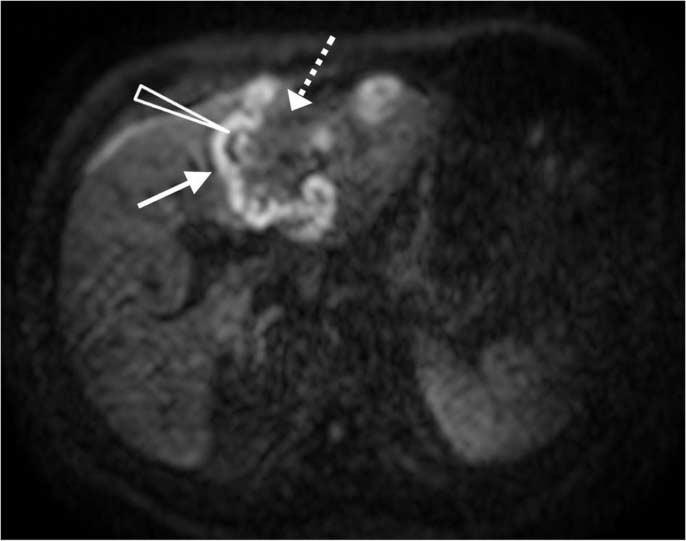 of the lesion: lymphoma with very low signal intensity area (arrow) and slightly low signal intensity entrapped by the tumor