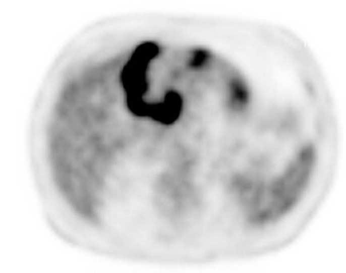 (g) Axial diffusion-weighed image (b = 800) shows three different signal intensity of the lesion: a bandlike high signal