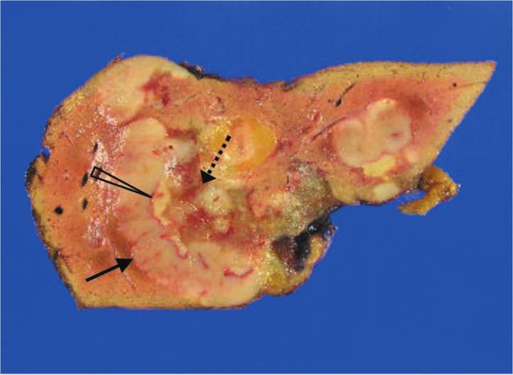 (arrowhead), consistent with necrotic tumor, and intermediate signal intensity area (dotted arrow) entrapped by the tumor