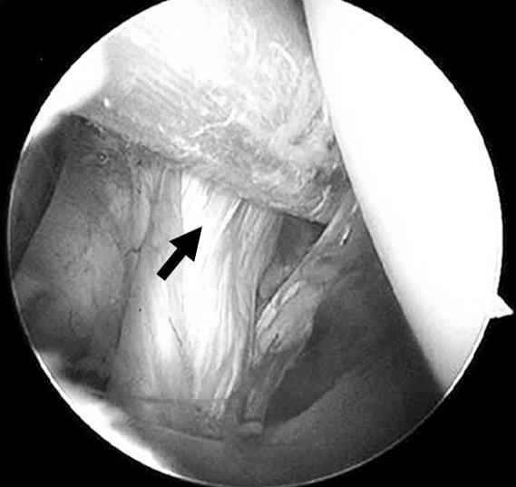 395 Figure 3. Concomitant lesions of long head of biceps tendon. (A) Partial tear of biceps tendon.