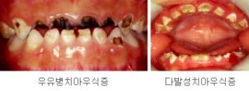 영아기의영양건강문제 성장장애 : 영아의신장과체중이자신의월령에따른성장곡선에서 5 분위수미만인경우성장장애로진단 빈혈 : 철결핍성빈혈이가장흔함.