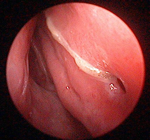 Fig. 2. Well healed perforation edge. There is no exposed cartilage resulting in no chondritis.