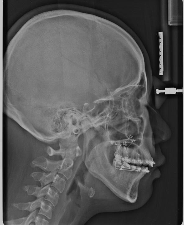 골격성개방교합을보이는 II 급장안모환자에서피질골절제술 (Corticotomy)