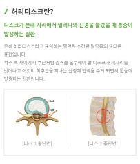 허리? 무릎? 무엇이든검색해보세요! 나누리병원홈페이지 검색 기능을이용해보세요. 원인과증상부터치료방법까지더알차고풍부해진척추 관절건강정보가여러분을기다립니다. 신뢰할수있는나누리병원의건강정보. 일러스트그림과 3D 영상으로이해하기도참 ~ 쉽죠? 03_ 회원가입없이간편하게진료예약하세요!