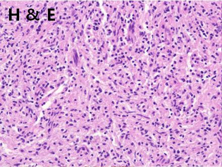 The right frontal lobe biopsy shows