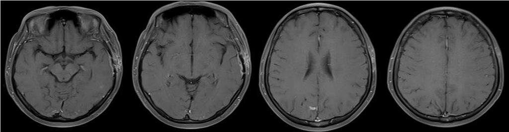 Previous observed lesions are almost