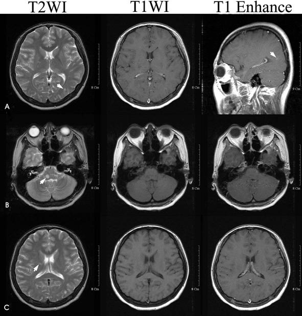 Interferon-β 를사용하던다발성경화증환자에서발생한만성염증성탈수초성다발성신경병증 Figure 1. Brain MRI. Upper row (A) reveals a Gadolinum-enhanced small lesion in juxtacortical area in left parietal cortex.