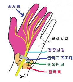 수근관증후군 ( 손목터널증후군, 팔목터널증후군 ) 수근관증후군은손에과도한힘을주어사용하거나손목을반복적으로구부리거나꺽인상태에서오래일하는경우발생하는대표적인업무상근골격계질환이다. 1수근관 ( 손목터널 ) : 손목에있는팔목뼈와이를지지하는횡인대로구성된터널모양의구조물인데, 이사이로정중신경이지나간다.
