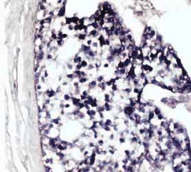 56 배영경 김동석 이수정외 1 인 A B Fig. 2. Human telomomerase mrna expression in ductal carcinoma in situ. Most tumor cells show diffuse and strong expression. Fig. 3.