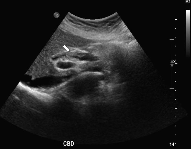 - The Korean Journal of Medicine: Vol. 88, No. 2, 2015 - Figure 1. Abdominal ultrasonogram showing irregular wall thickening and luminal narrowing of the common hepatic duct (arrow).