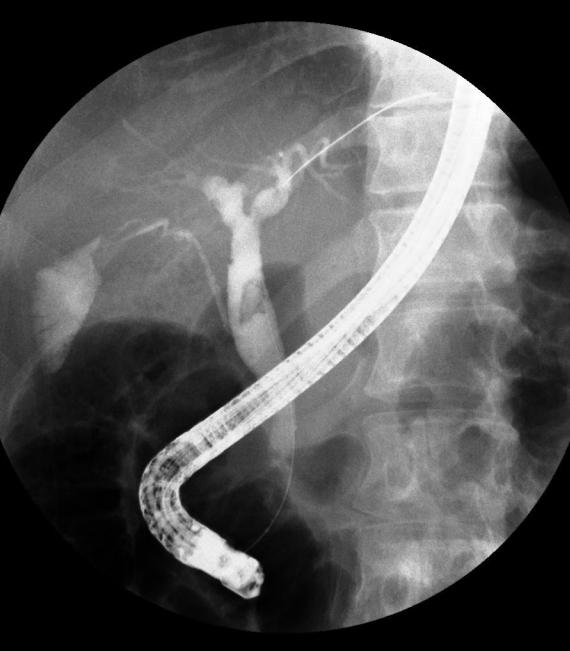 - Su-Young Park, et al. A case of biliary fascioliasis - Figure 4. After sphincterotomy, the Fasciola hepatica worm was extracted using a balloon catheter. Figure 3.