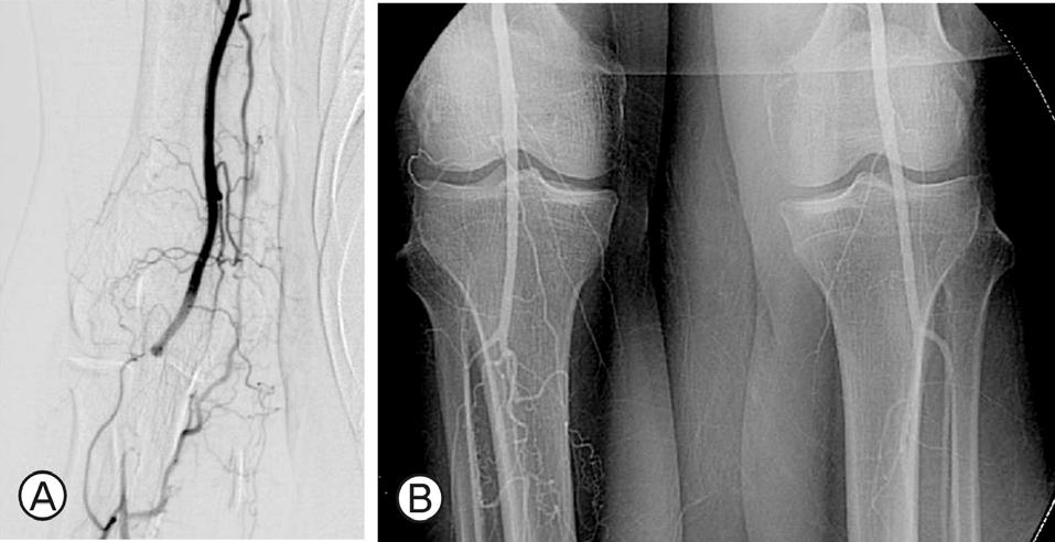 Sejin Hwang, et al: A Case of Pasteurella Multocida Endocarditis 만성간질환을가지고있었다 6-14). 이중성공적으로치료된환자들의반수이상에서수술적치료가필요하였다. 국내에서는 P. multocida 에의한자연판막심내막염 2예가보고되었으나인공판막심내막염에대한증례보고는없었다 6,7).