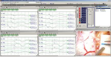 median nerve ; 15 ma, 0.3 msec, 5.1 Hz post tibials nerve ; 20 ma, 0.