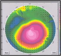 명확한원추모양 (cone shape), 사진각막계상의원 (Photokeratoscopic