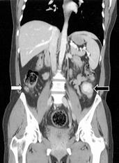 Intest Res : Vol. 5, No. 1, 2007 Fig. 1. Abdominal CT findings (A, B). A 2.