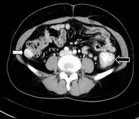 3 cm sized lobulated mass is also noted in the mid-descending colon (black arrow). Fig. 2. (A) Colonoscopic finding.