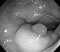 The inhomogeneous 3 cm sized mass like lesion is separated by the serosal layer and no association with the serosal layer. It destructs all layers of bowel.
