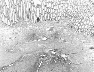 Hyun Seok Cho, et al:a Case of Multiple Deep Infiltrating Intestinal Endometriosis Presenting as Abdominal Mass 시행하였고, 각각의종괴를절제하였다.