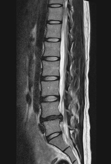 부분마취후가느다란내시경관 (7mm) 을삽입합니다. 2. 내시경관안으로내시경을넣고모니터로병변을확대해확인합니다. 3. 미세도구로협착증의원인이되는인대나뼈를제거해척추관을넓혀줍니다.