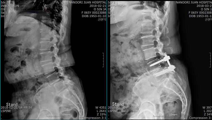 (Ube Lumbar Interbody Fusion) 걷기만하면종아리가터질것같은통증때문에집밖을나서기두려웠다는오신자님 ( 여 65세). 척추관협착증에척추전방전위증까지앓고있어길을걷다보면몇번씩쉬었다움직여야했다. 여러병원을다녀봤지만그가나누리병원에서치료를 결심하게된이유는 척추내시경 때문이라고말했다. 다른병원에서는뼈를고정하는수술은피부절개가불가피하다고했다.