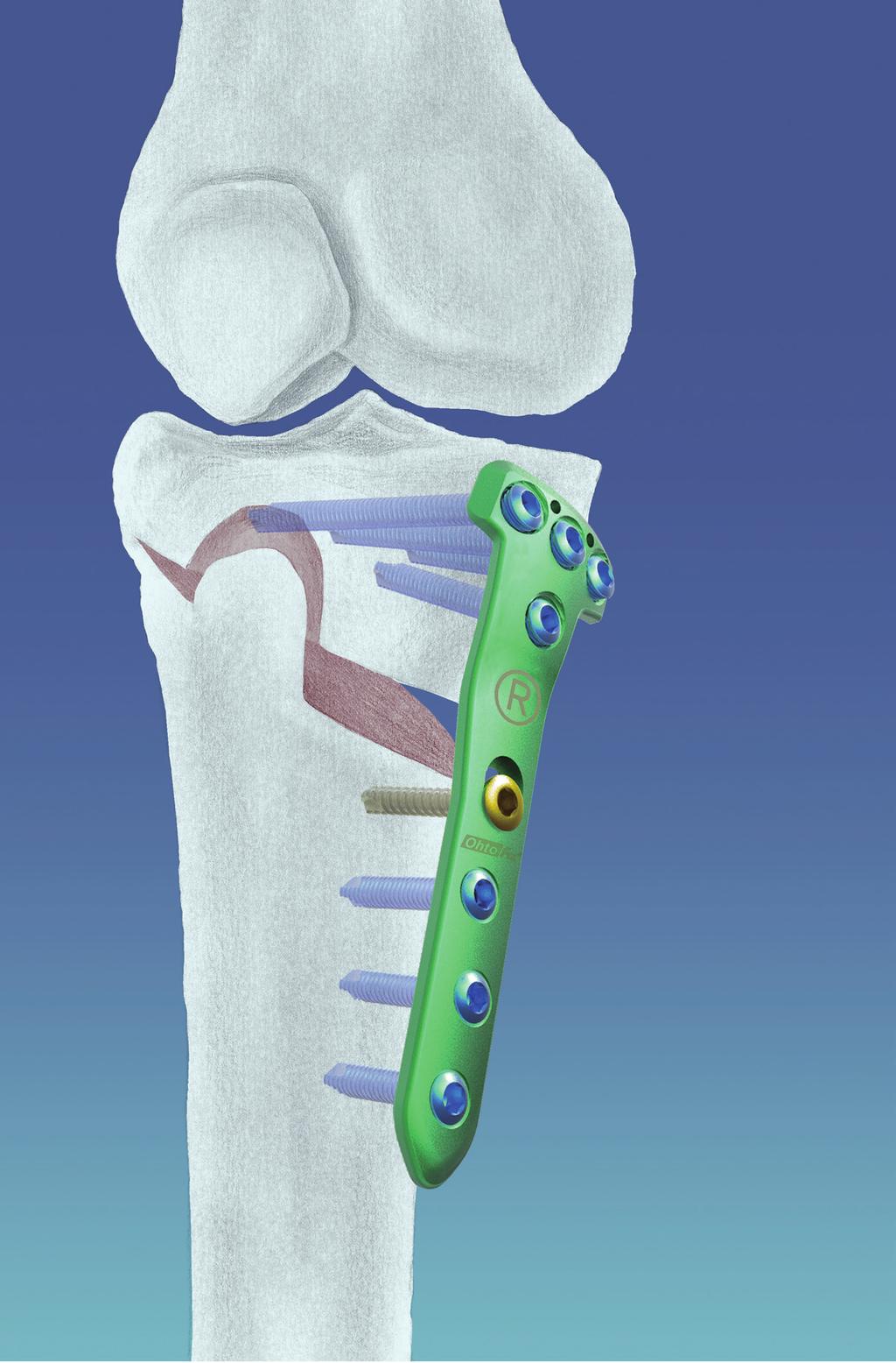 Osteotomy Surgical