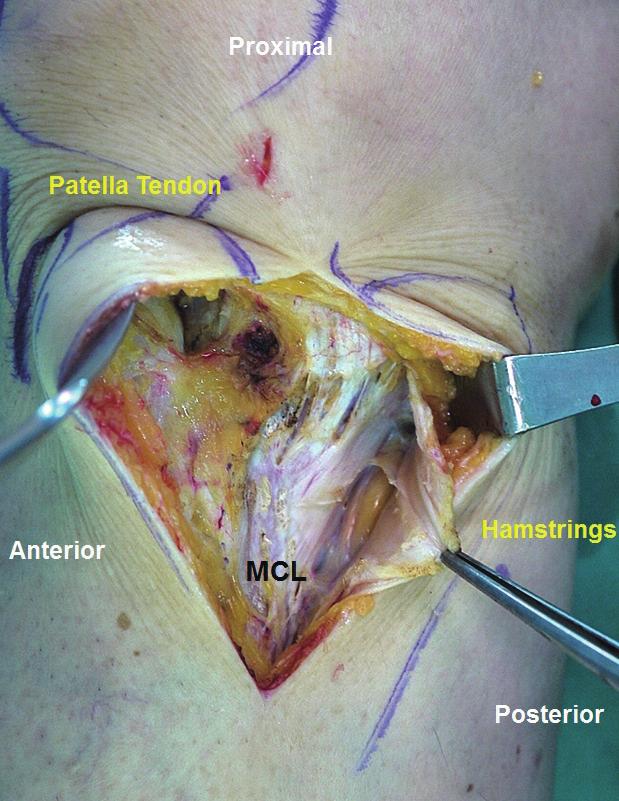 Patella tendon 내측면과 tibia의 posterior border의중간부위에약 5-6cm의 Longitudinal로절개합니다. Patella tendon의 insertion 부위를노출시킨후 Homan retractor로 anterior를 retraction시킵니다.