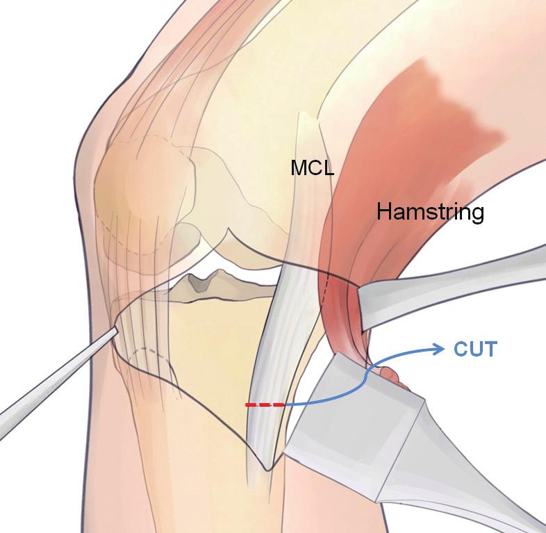 3. Approach MCL Exposure <Method 1> Hamstring tendon 을 posteromedial 로 retraction 한후 MCL (Superficial) 을노출시킵니다.