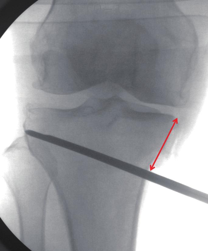 Osteotomy 1. Insertion of Guide Pin 1 Knee joint 를 slightly flexion 하고 C-arm 으로 tibia joint 와 평행하게이미지를비출수있게합니다. 전방 K-wire (ø 2.0-2.4mm) 를 safe zone 로향해 삽입합니다.