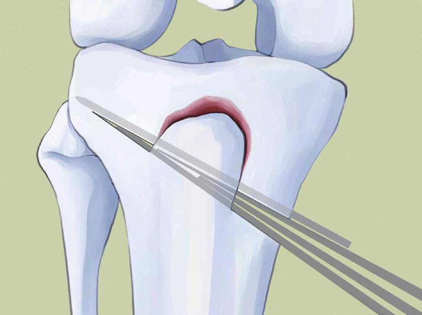 ( 절골면의약 50-60% 는 oscilliating saw를사용하고이후절골도를사용하여조심스럽게그러나충분히절골술을시행합니다 ) 이후두번째절골술은첫번째절개된면에대하여약