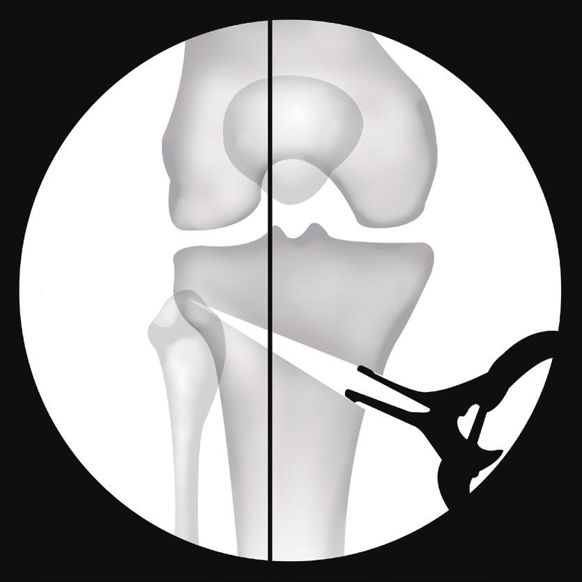 (3) 고식적인방법 (Conventional Method) - Intraoperative C-arm Method - 1. Osteotomy 를시행한후 osteotomy 절개면을열어줍니다. 2.