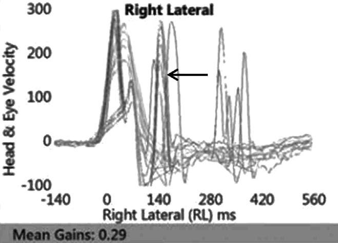 두부충동검사 결과와 달리 없었던 반보상성 단속운동이 나타나기 시작하였다 Fig. 4. Patterns of positive eye velocity SHIMP (below) in patient with left Meniere s disease.