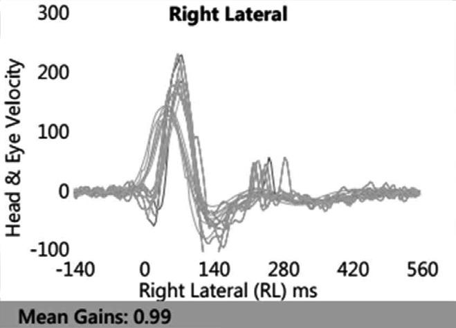 Patterns of positive eye velocity SHIMP (below) in patient with bilateral vestibular function loss. Remarkable compensatory saccadic eye movements (arrow: VOR gain 0.