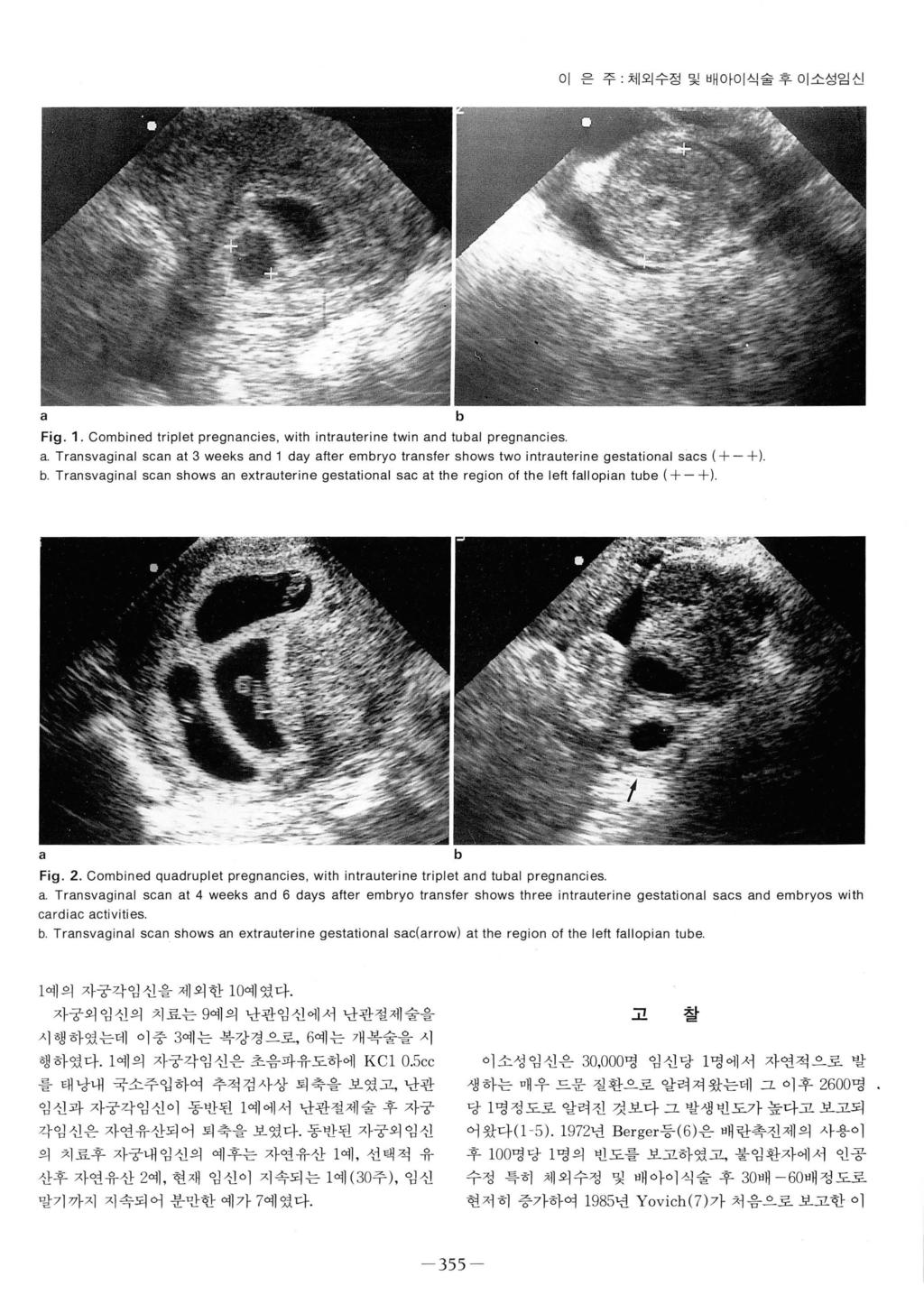 이 은주체외수정및배아이식술후이소성임신 a b Fig. 1. Combined triplet pregnancies, with intrauterine twin and tubal pregnancies a.