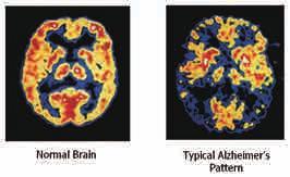 핵의학 PET/CT 의임상적용 < 그림 11> 뇌 FDG-PET 검사에서의 Normal 과 Alzheimer disease 고려하거나 FDG