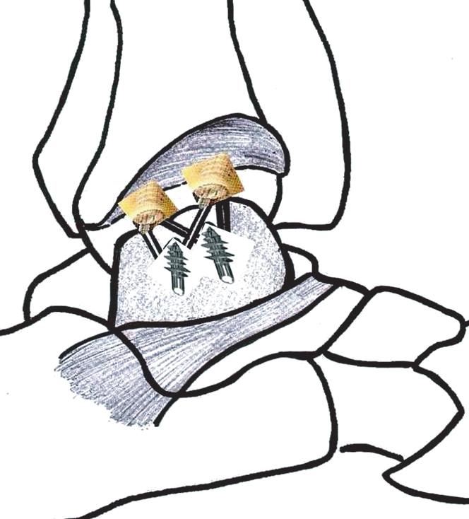 Ji-Kang Park, et al. Modified Brostrom Procedure with Suture Bridge 109 한재건술이가장이상적인수술방법으로알려져왔다. 9-11) 그러나최근에는운동선수에서의만성발목관절불안정성에대한일차적인수술방법으로변형 Brostrom 술식과같은해부학적인대재건술을권장하는보고가많아지고있다.