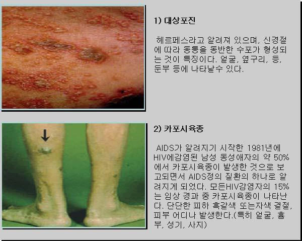 일부감염자는 HIV 소모성증후군 (HIV wasting syndrome) 을겪게되는데, 이는다른원인으로설명할수없는 10 % 이상의체중감소, 30일이상지속되는설사와발열등의증상을나타낸다. HIV에감염된후 AIDS로진행되기까지의기간은사람마다차이가많지만전파경로에관계없이, 50 % 의감염자가 AIDS로진행되는데약 10년이소요되는것으로알려져있다.