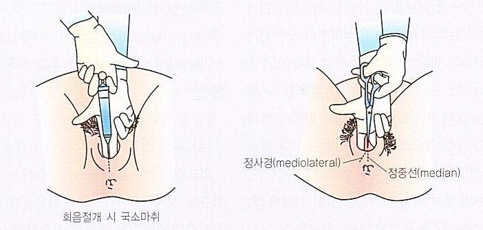 병원마다좌욕방법이다르기도한데소독대야에약물을타서쓰기도하고비데와같은좌욕기를쓰기도한다. 상처가잘회복되는상태라면퇴원후가정에서는샤워기를이용해따뜻한물로 10~15분정도, 하루에 3~4회좌욕을하면편안함을느낄것이다. 이때배뇨나배변작용이촉진되기도한다. 질안은정상산도를유지해야하므로질안까지씻지않아야한다. 세균좌욕후에는상처부위를잘건조시키고깨끗한패드를착용한다.