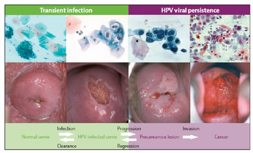 HPV 에노출될위험은나이가들면서상당부분감소하지만, 그대신나이든여성은젊은여성에비 해지속감염의위험이상대적으로더높다. 9-11 비록모든병변이침윤암으로진행하지는않지만, 병 변이소실되지않고더오래지속될수록고등급병변및침윤암으로진행돨가능성이높아지게된다 (Fig. 7). 12-14 Fig 7.