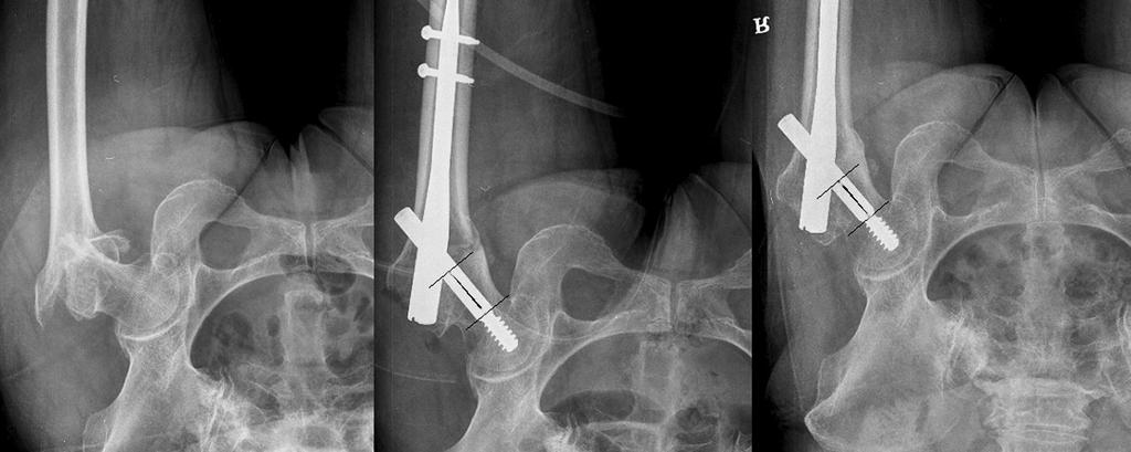 1 98.2 2.2 26.0 Fig. 1. (A) 72 years old female who had trochanteric fracture by slip down. (B) Treated with ITST nail. Postoperative AP view, length of lag screw was 36.2 mm.