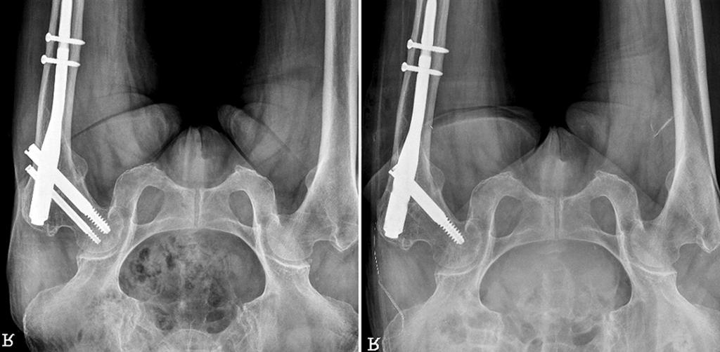 ) Stable Unstable Totally Lag screw sliding (mm) Stable Unstable Totally Change of neck-shaft angle ( o ) 4.6 5.6 5.3 4.7 5.9 5.5 나타내었다. 지연 나사의 평균 활강은 ITST 군에서 4.1 mm (0 12.5 mm), 군에서는 6.6 mm (2.