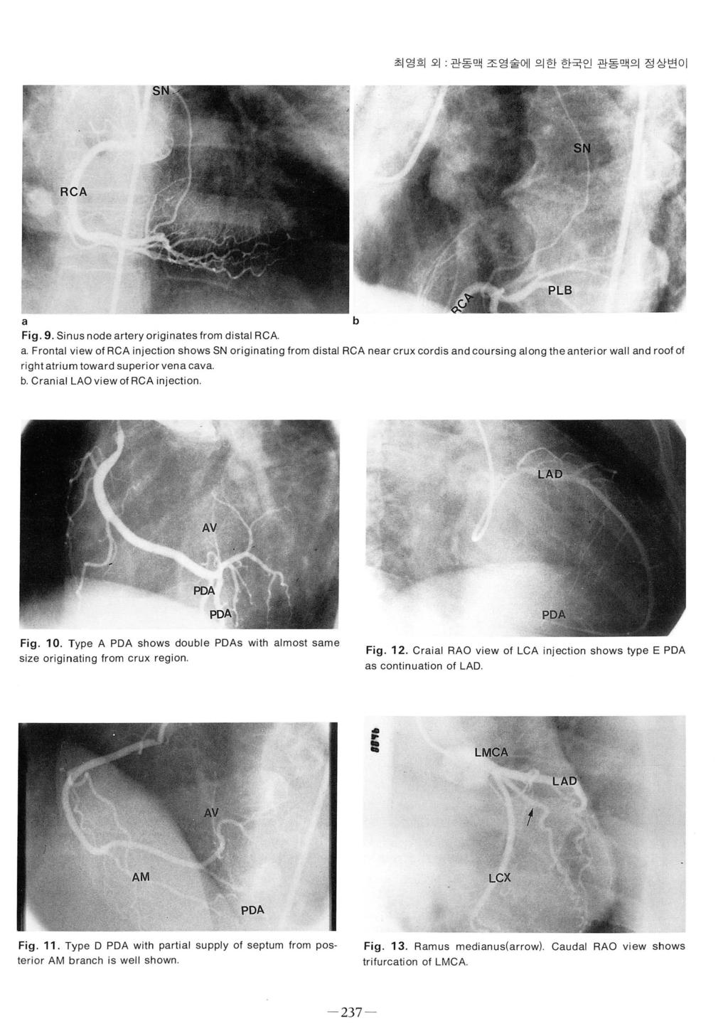 ? ι최영희외 관동맥조영술에의한한국인관동맥의정상변이 a b Fig. 9. Sinus node artery originates Irom distal RCA a.