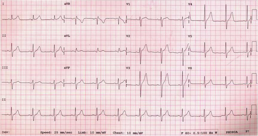 The twelve-lead ECG on admission: marked ST segment elevations were noted on the right precordial leads (V1-V4) and