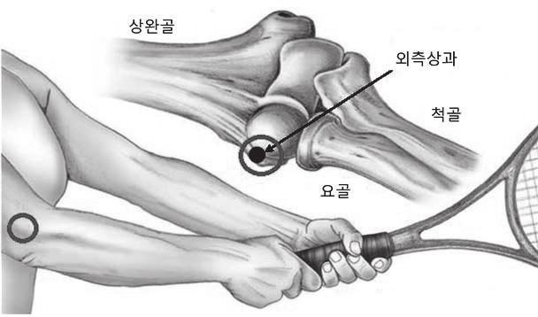기초정보 팔꿈치관절은위쪽의상완골과아래쪽의척골 ( 새끼손가락쪽 ) 및요골 ( 엄지쪽 ) 로이루어지는관절로구부러지고펴지는운동과손목과함께아래팔이회전하는두가지운동이일어나는상지의관절입니다. 3개의뼈들이서로안정적으로접해져있으며양측으로측부인대들이연결되어있으며손목과손을움직이는근육들이관절위에서시작되어손으로내려갑니다.