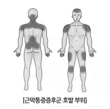 근막통증후군, 아래팔 M79.