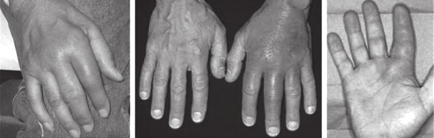건막염은힘줄 ( 건 ) 을둘러싸고있는건막에국소적인염증반응이발생하면서통증이유발되는것을 의미합니다. 앞서살펴본 드퀘르벵병 은손목건초염중에서가장흔한것이고, 손이나손목어느 부위에서나발생할수있습니다. 질병정보 손 손목의건 ( 초 ) 염 윤활막염 은건 ( 힘줄 ) 주변의보호막 ( 건초 ) 염증을동반한건염입니다. 움직일때특히나힘줄이아프고, 때때로부어오릅니다.