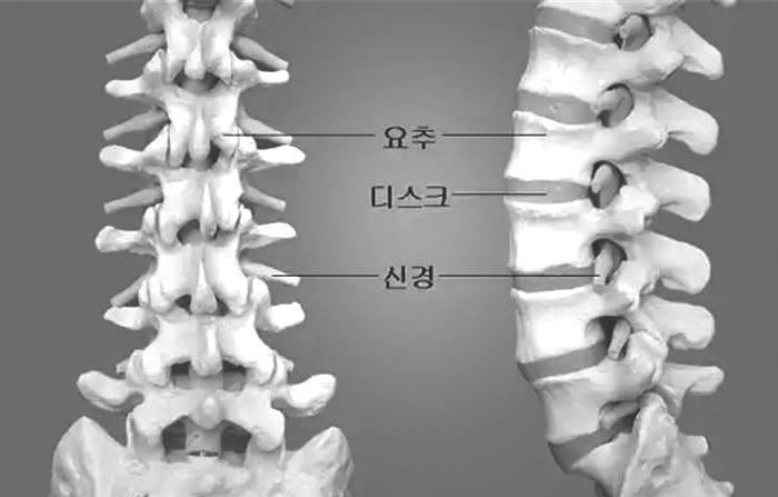 1 아래허리통증 ( 요통 ), ( 요부긴장 / 염좌, Low Back strain/sprain) M54.5, S33.5 요통 M54.5 Low back pain 옆구리통증아래허리긴장요통 NOS < 제외 > 추간판전위로인한요통 (M51.2) / 좌골신경통을동반한요통 (M54.