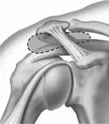 회전근개란어깨와팔을연결하는 4개의근육 ( 극상근, 극하근, 소원근, 겹갑하근 ) 및힘줄로이루어져있는구조입니다. 이러한회전근개는팔 ( 어깨 ) 을회전시키고, 다른어깨관절의근육, 힘줄, 인대들과함께관절주위의안전성을제공하는역할을합니다. 이 4가지근육은주로외전, 외회전, 내회전등 3가지기본운동에관여합니다.